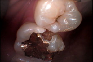 虫歯の再発