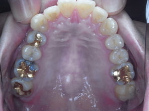 虫歯の再発