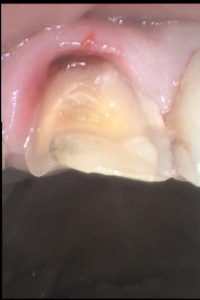 前歯の破折