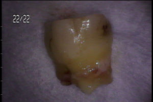 歯の破折