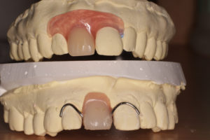 前歯の破折