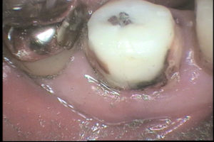歯根破折　分割