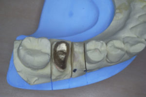 歯根破折　分割