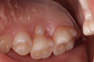 乳歯交換