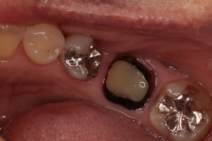 1本義歯の効用と限界