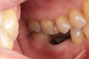 1本義歯の効用と限界