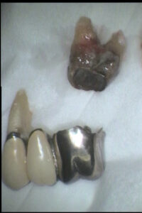 入れ歯作成から修理