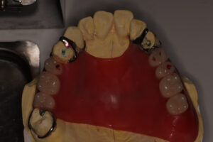 入れ歯作成から修理